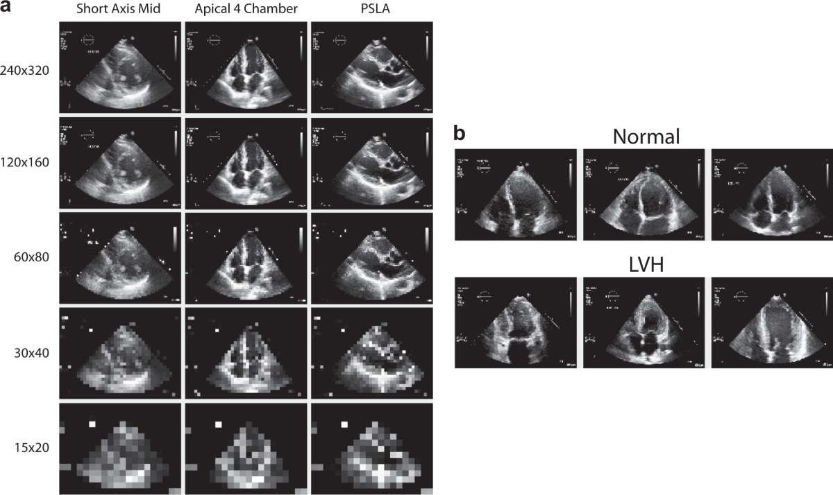 Deep echocardiography: data-efficient supervised and semi-supervised deep  learning towards automated diagnosis of cardiac disease | npj Digital  Medicine