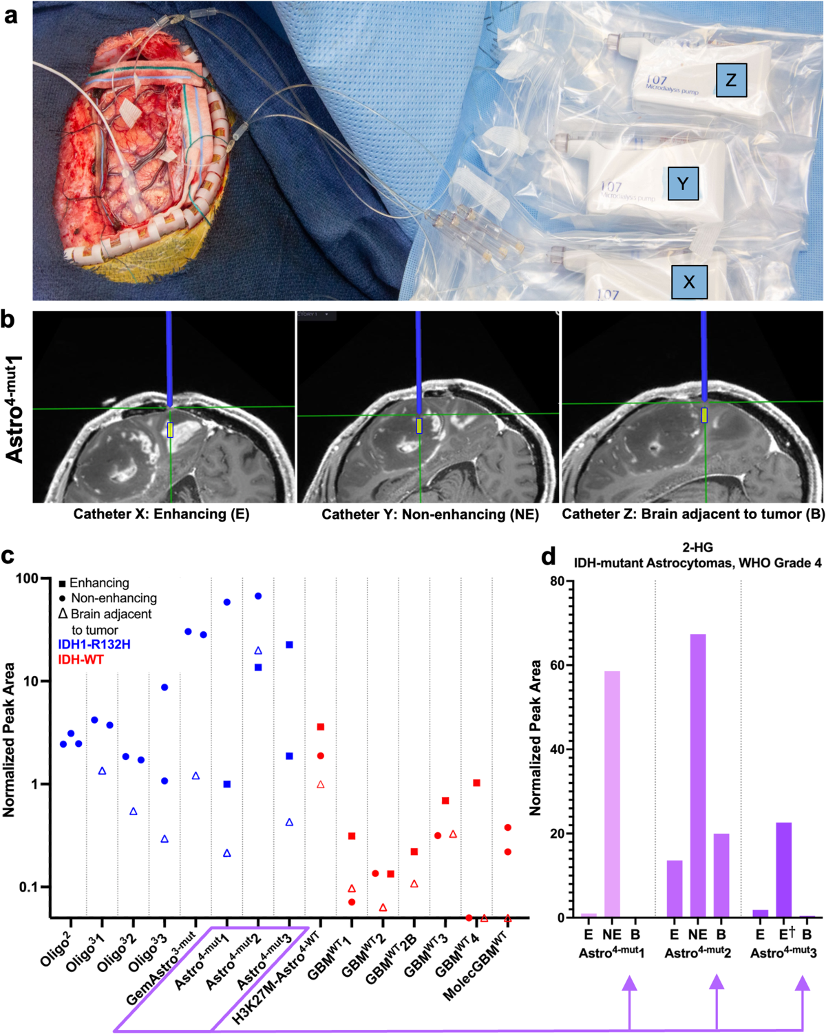 Blood-brain barrier disruption defines the extracellular metabolome of live  human high-grade gliomas | Communications Biology