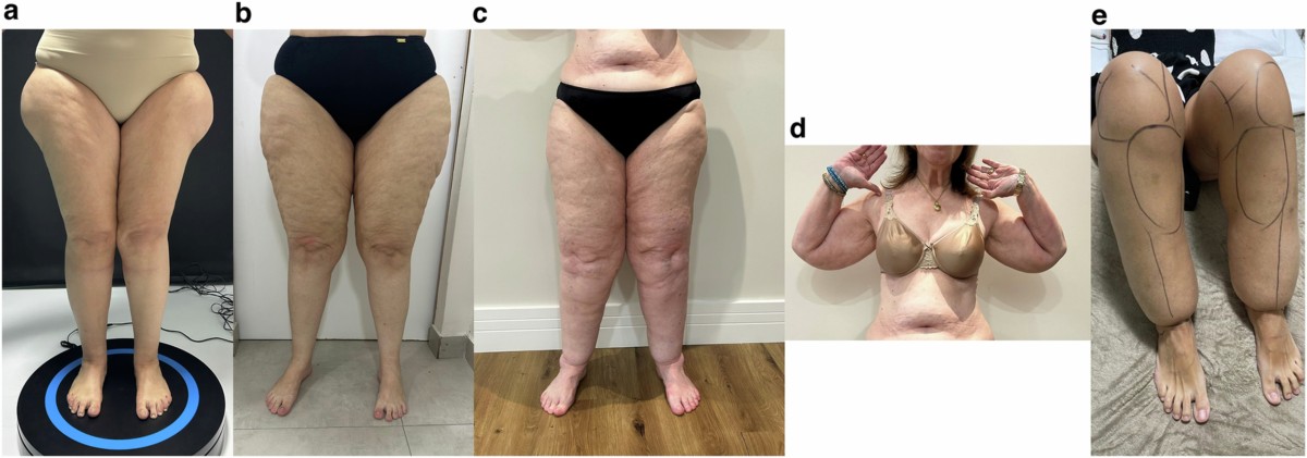 half life glutathione Compounded Glutathione Injection
