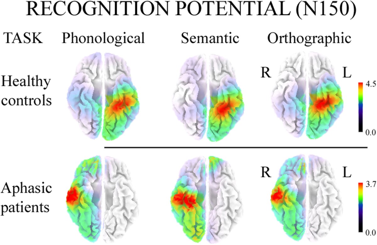 Brain plasticity in aphasic patients: intra- and inter-hemispheric  reorganisation of the whole linguistic network probed by N150 and N350  components | Scientific Reports