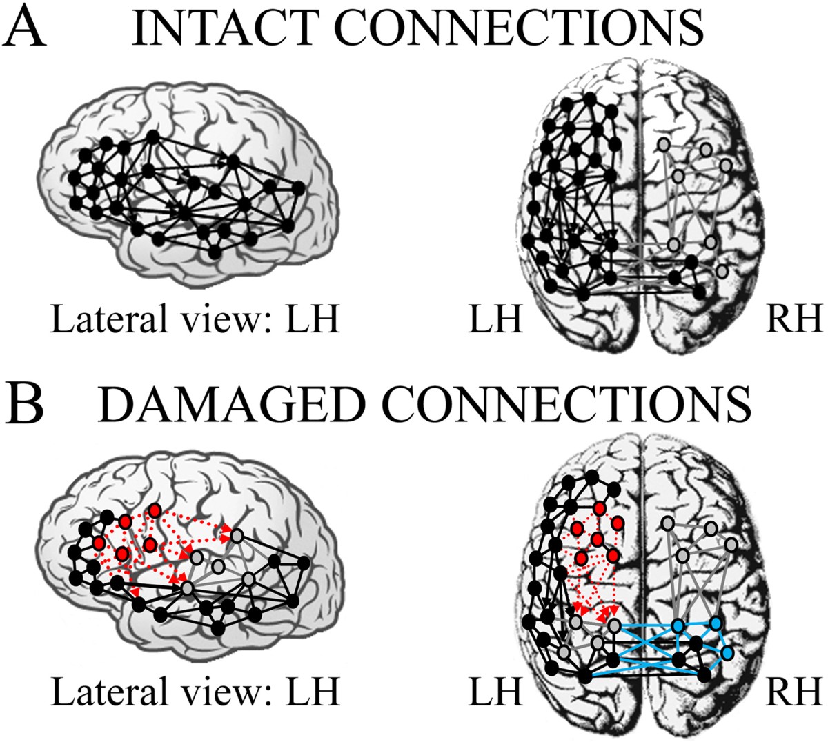 Brain plasticity in aphasic patients: intra- and inter-hemispheric  reorganisation of the whole linguistic network probed by N150 and N350  components | Scientific Reports