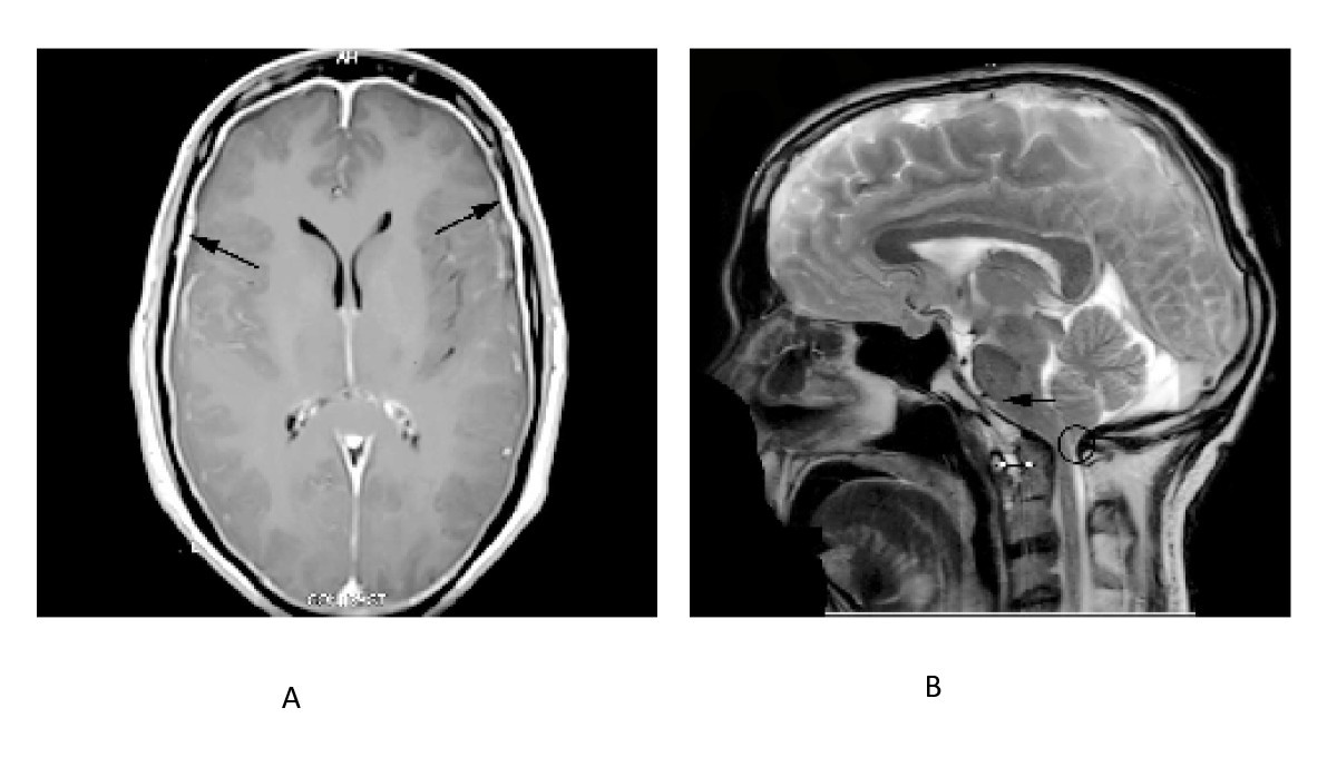 Spontaneous dural tear leading to intracranial hypotension and tonsillar herniation in Marfan syndrome: a case report | BMC Neurology | Springer Nature Link