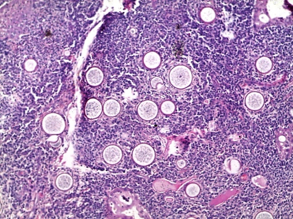 Ocular rhinosporidiosis mimicking conjunctival squamous papilloma in Kenya – a case report | BMC Ophthalmology | Full Text