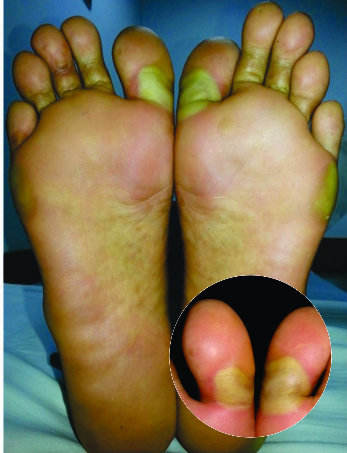 Hand-foot syndrome associated with use of sorafenib in a patient with  papillary thyroid cancer: a case report | BMC Endocrine Disorders |  Springer Nature Link