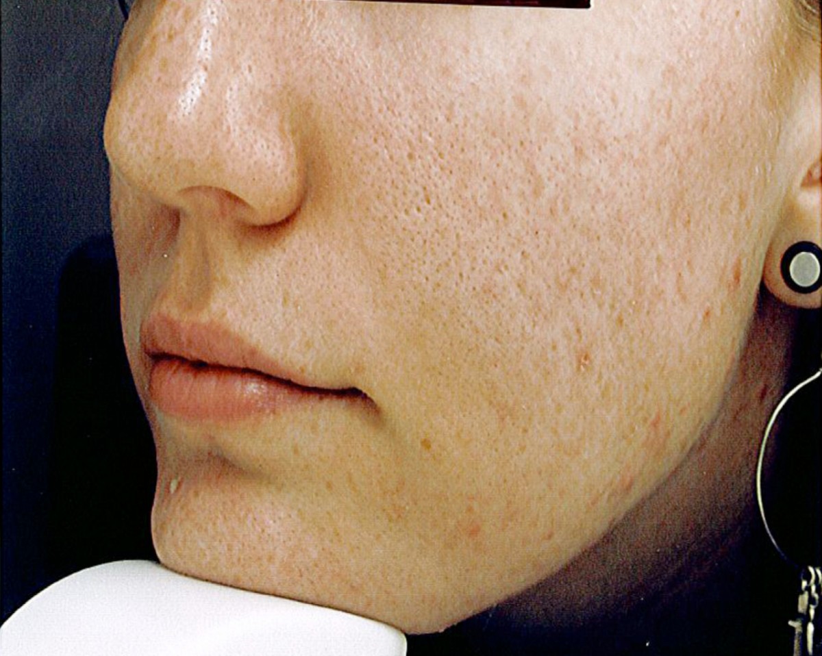 glutathione deficiency acne Acne vulgaris, mental health and omega-3 fatty acids: a report of cases |  Lipids in Health and Disease