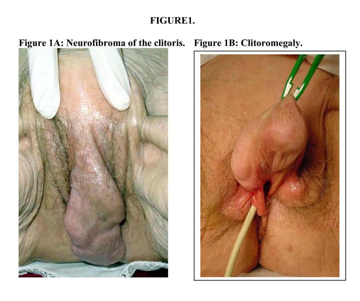 clitorectomy Clitoridectomy, Illustration - Album alb3788993