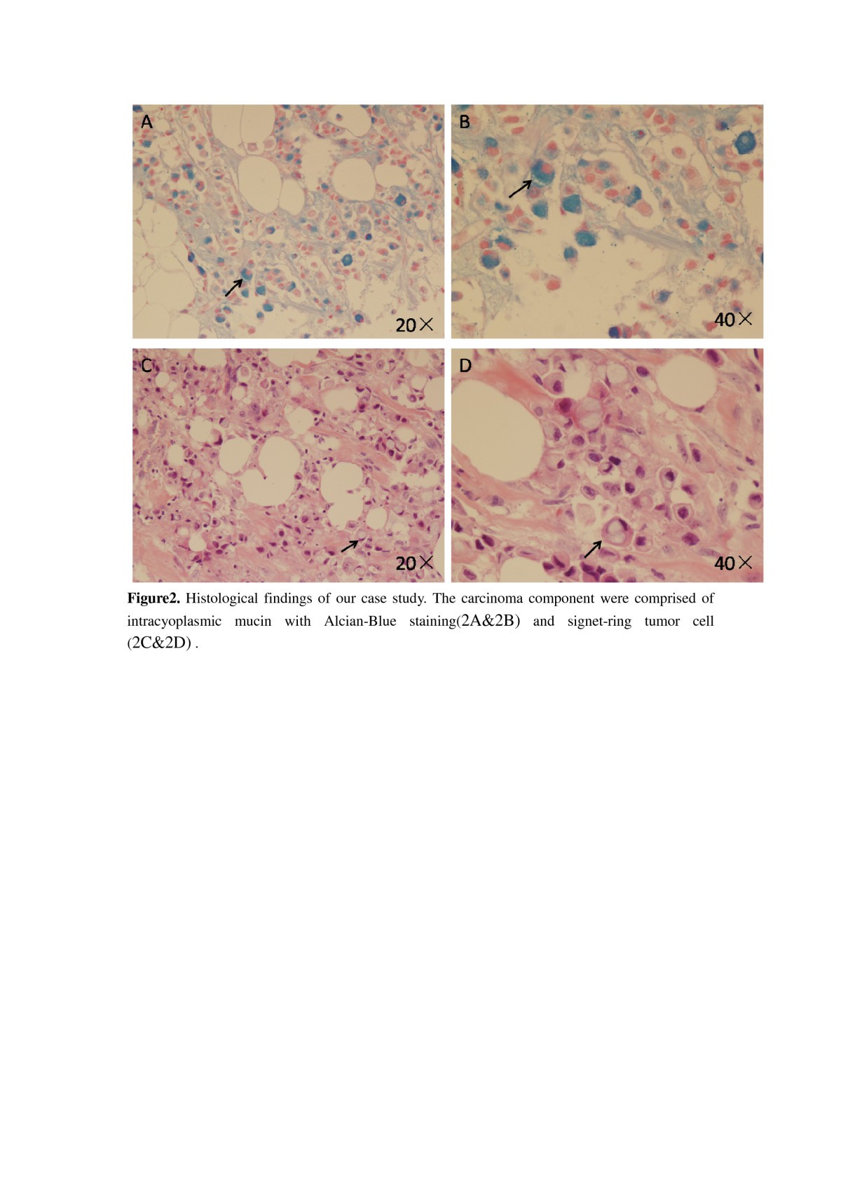 The clinicopathological and immunohistochemical features of breast  carcinomas with signet-ring-cell differentiation | World Journal of  Surgical Oncology | Full Text