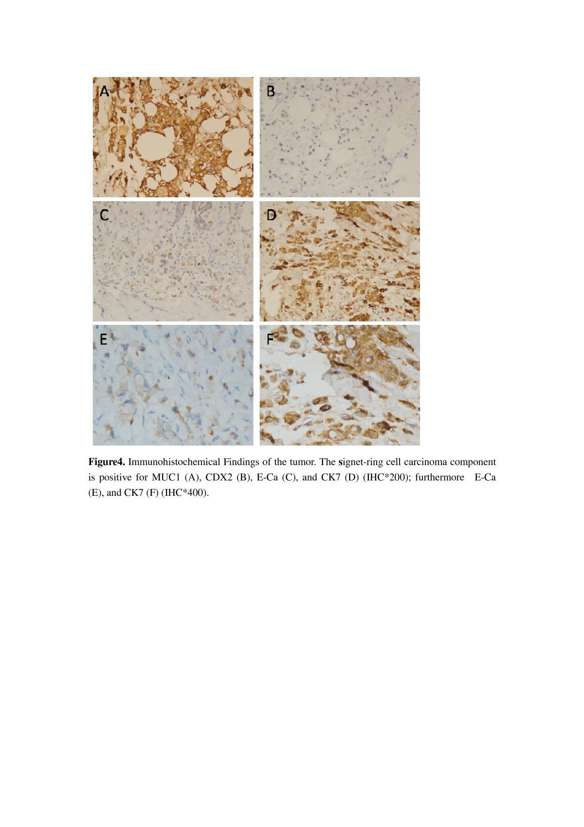Journal of Oncology Research and Treatment - A Rare Case of Pulmonary  Anaplastic Lymphoma Kinase Positive Signet Ring Cell Carcinoma in A  Japanese Male
