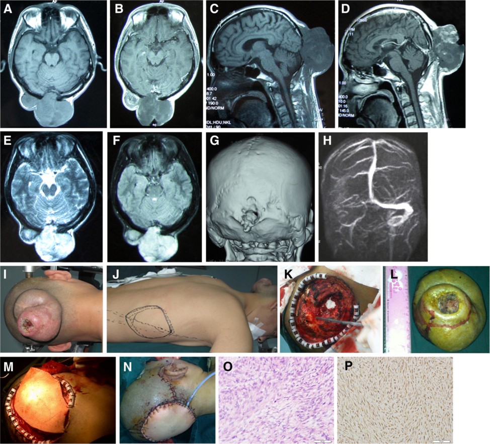 metastatic melanotic peripheral nerve sheath sarcoma prognosis Microsurgical management of giant malignant peripheral nerve sheath tumor of the scalp: two case reports and a literature review | World Journal of Surgical Oncology