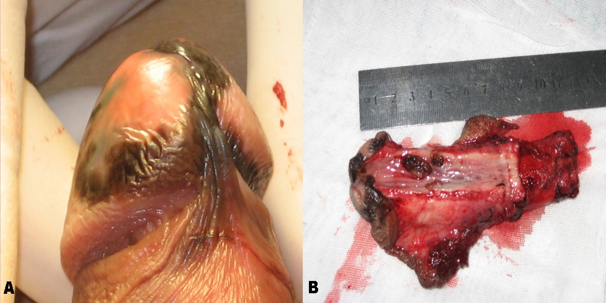 penile melanotic macule Malignant melanoma of the penis and urethra: one case report | World  Journal of Surgical Oncology