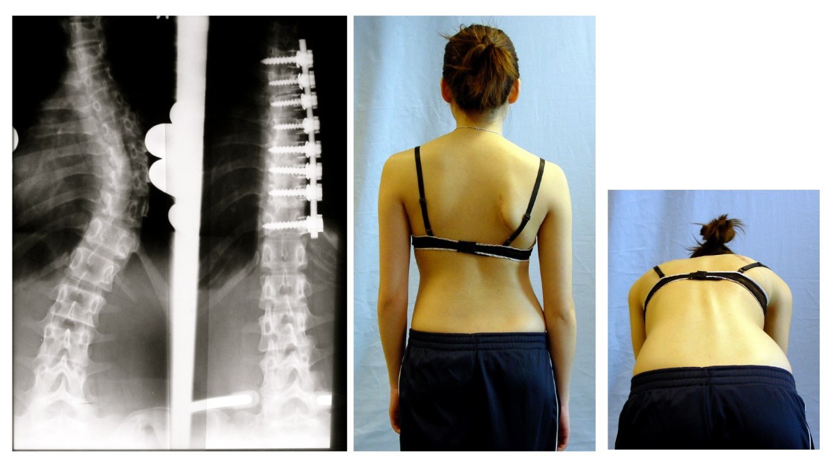 Rate of complications in scoliosis surgery – a systematic review of the Pub  Med literature | Scoliosis and Spinal Disorders | Full Text