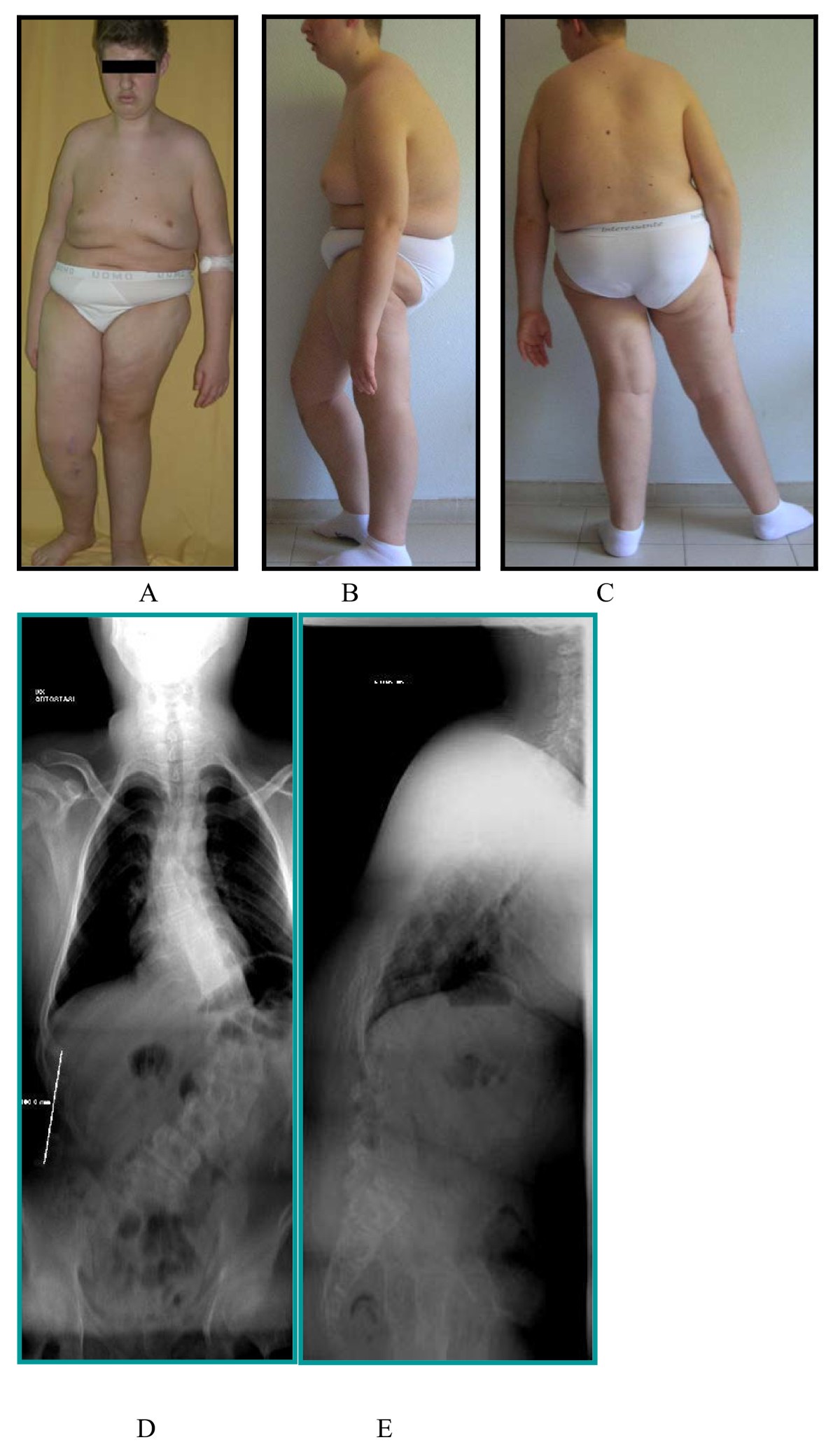 Treatment of scoliosis in patients affected with Prader-Willi syndrome  using various techniques | Scoliosis and Spinal Disorders | Full Text