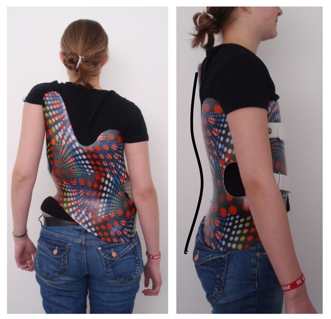 Brace technology" thematic series - the Gensingen brace™ in the treatment  of scoliosis | Scoliosis and Spinal Disorders | Full Text