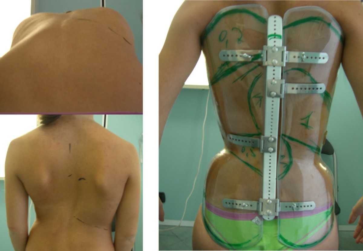 Brace technology thematic series - The Sforzesco and Sibilla braces, and  the SPoRT (Symmetric, Patient oriented, Rigid, Three-dimensional, active)  concept | Scoliosis and Spinal Disorders | Full Text