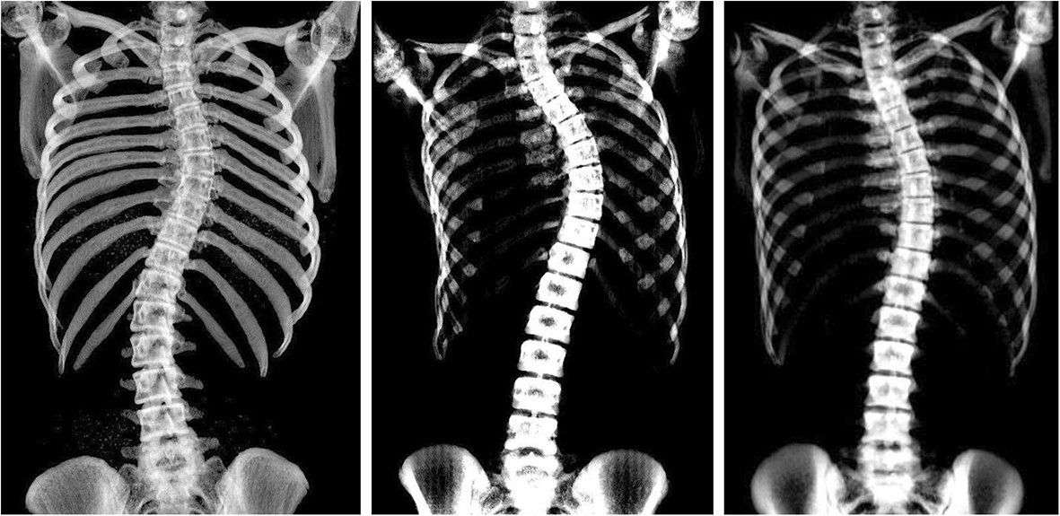 Supine to standing Cobb angle change in idiopathic scoliosis: the effect of endplate pre-selection | Scoliosis and Spinal Disorders | Full Text