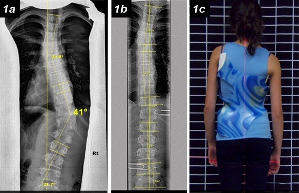 ما هو الهدف الأساسي من حزام اعوجاج العمود الفقري؟