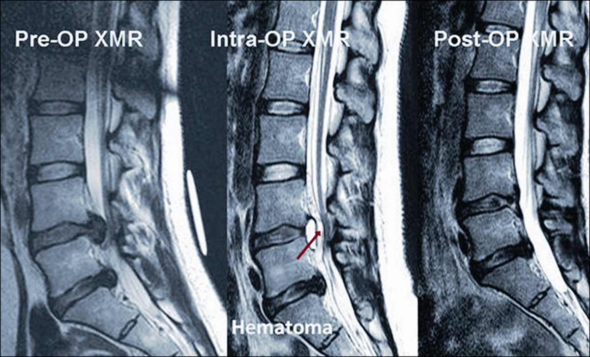Clinical results of XMR-assisted percutaneous transforaminal endoscopic  lumbar discectomy | Journal of Orthopaedic Surgery and Research | Springer  Nature Link