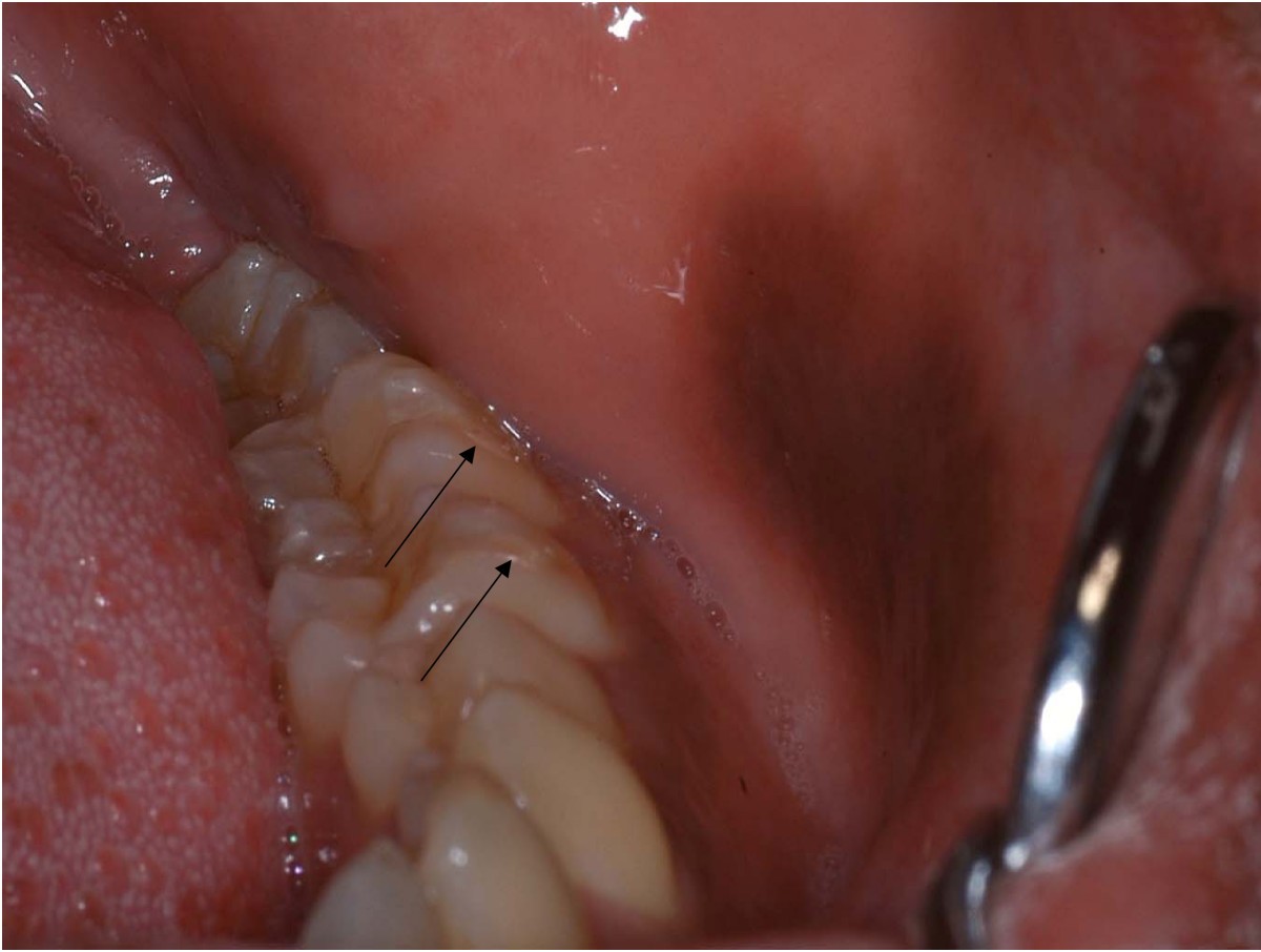 Oral melanoacanthoma: a case report and review of the literature | Journal  of Medical Case Reports