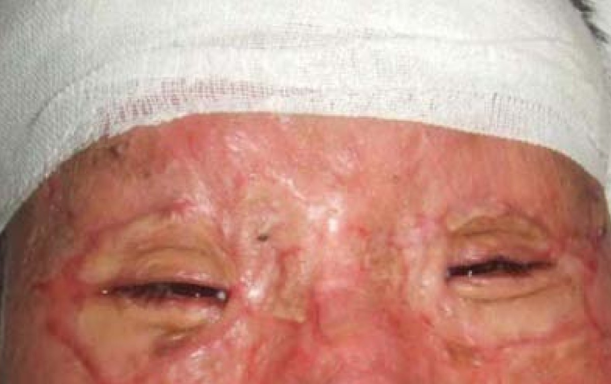 A modified surgical technique in the management of eyelid burns: a case  series | Journal of Medical Case Reports