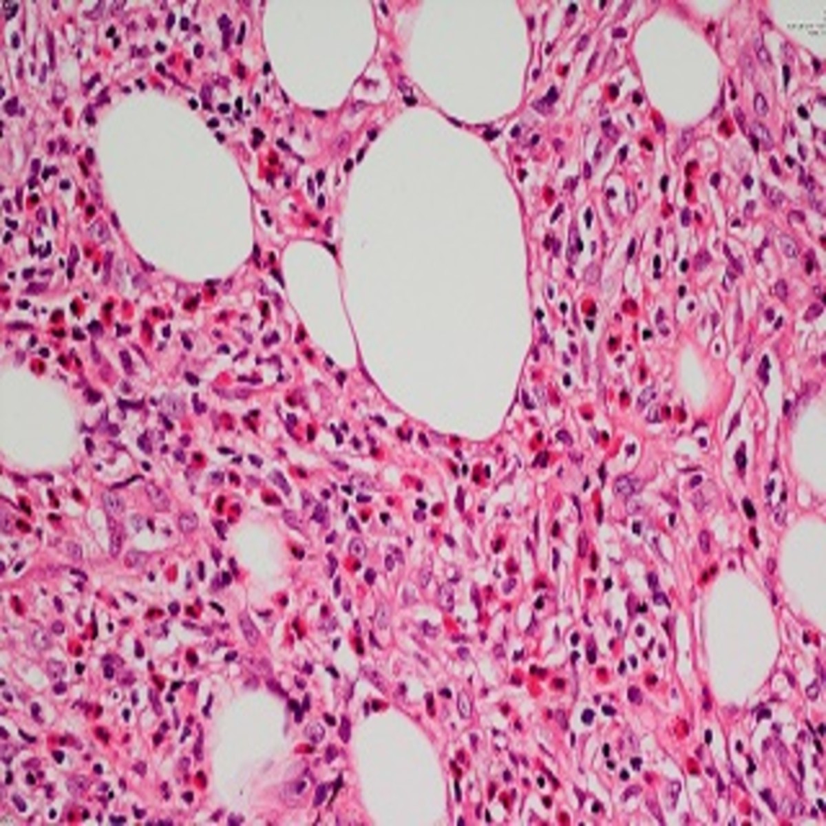 Tuberculous Cellulitis: Diseases Behind Cellulitislike Erythema | MDedge, image size:1200x1200