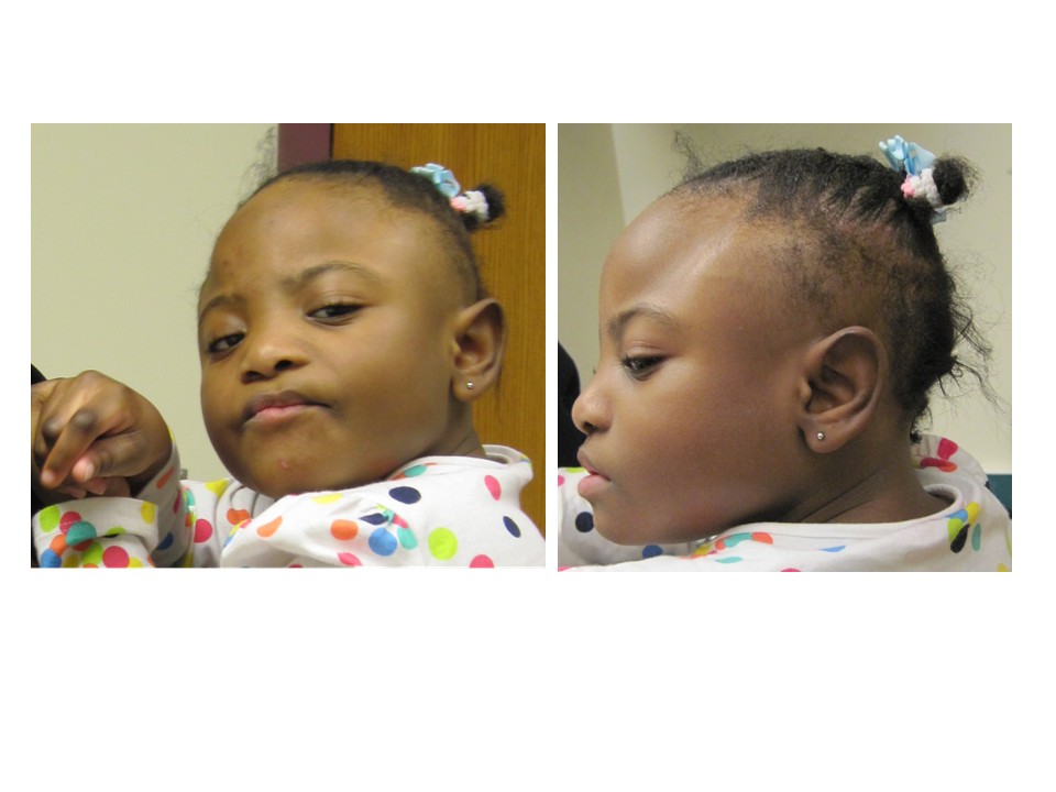 microcephalya preteen What The Mom Of Girls With Microcephaly Wants You To Know ...