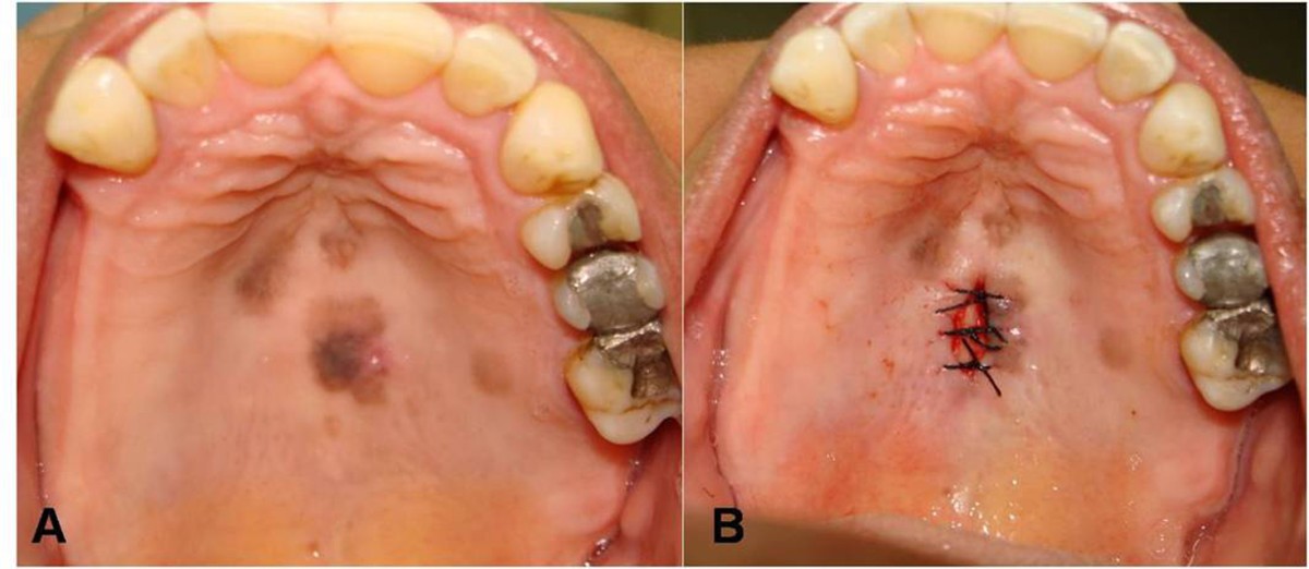 Immunohistochemical features of multifocal melanoacanthoma in the hard  palate: a case report | BMC Research Notes | Springer Nature Link