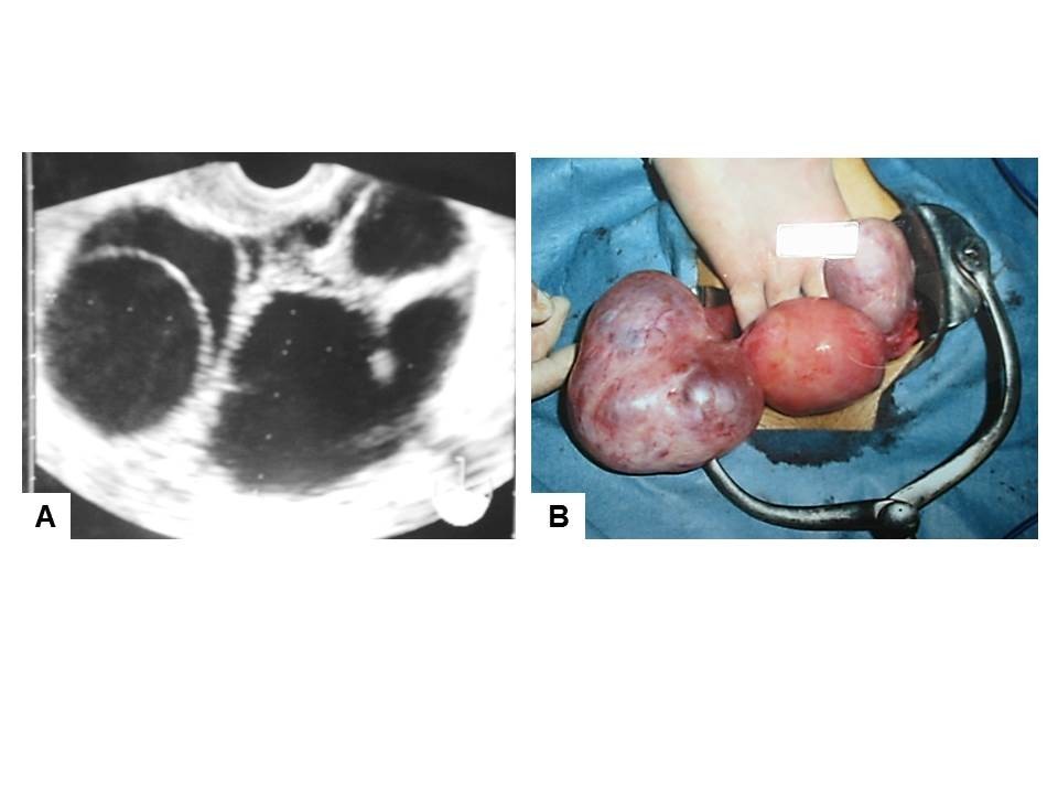 Follicle-stimulating hormone-secreting pituitary adenoma manifesting as recurrent ovarian cysts in a young woman – latent risk of unidentified ovarian hyperstimulation: a case report | BMC Research Notes
