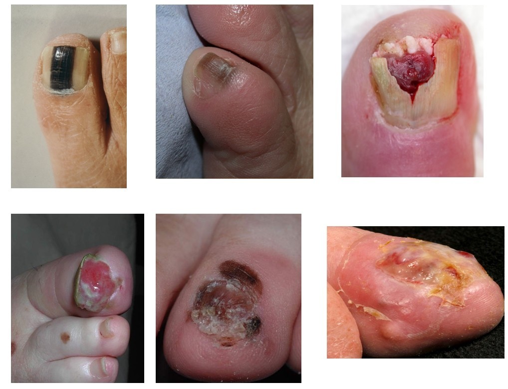 melanotic whitlow A Hidden Threat: Subungual Melanoma in Hand