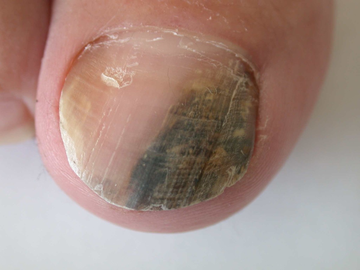 Clinical guidelines for the recognition of melanoma of the foot and nail  unit | Journal of Foot and Ankle Research