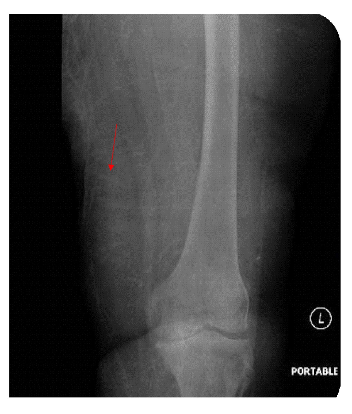 Tina Turner, Mismanaged High Blood Pressure \u0026 Chronic Kidney Failure –  Divabetic, image size:1200x1412