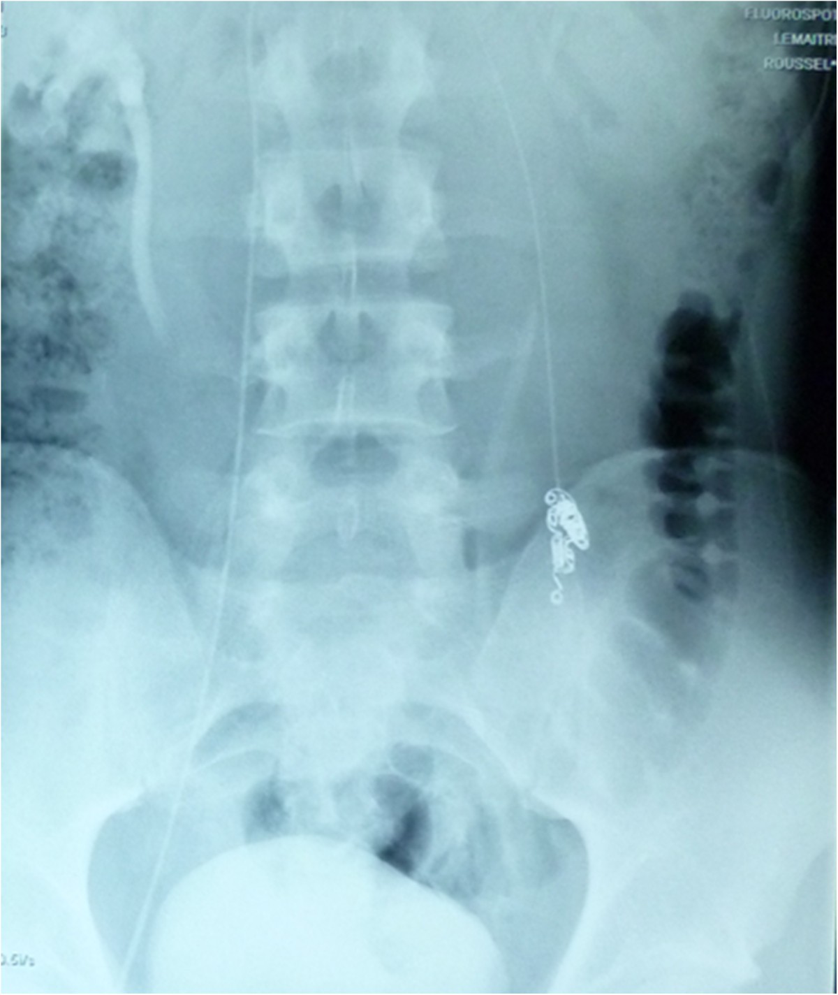 Beneficial effects of varicocele embolization on semen parameters | Basic  and Clinical Andrology | Full Text