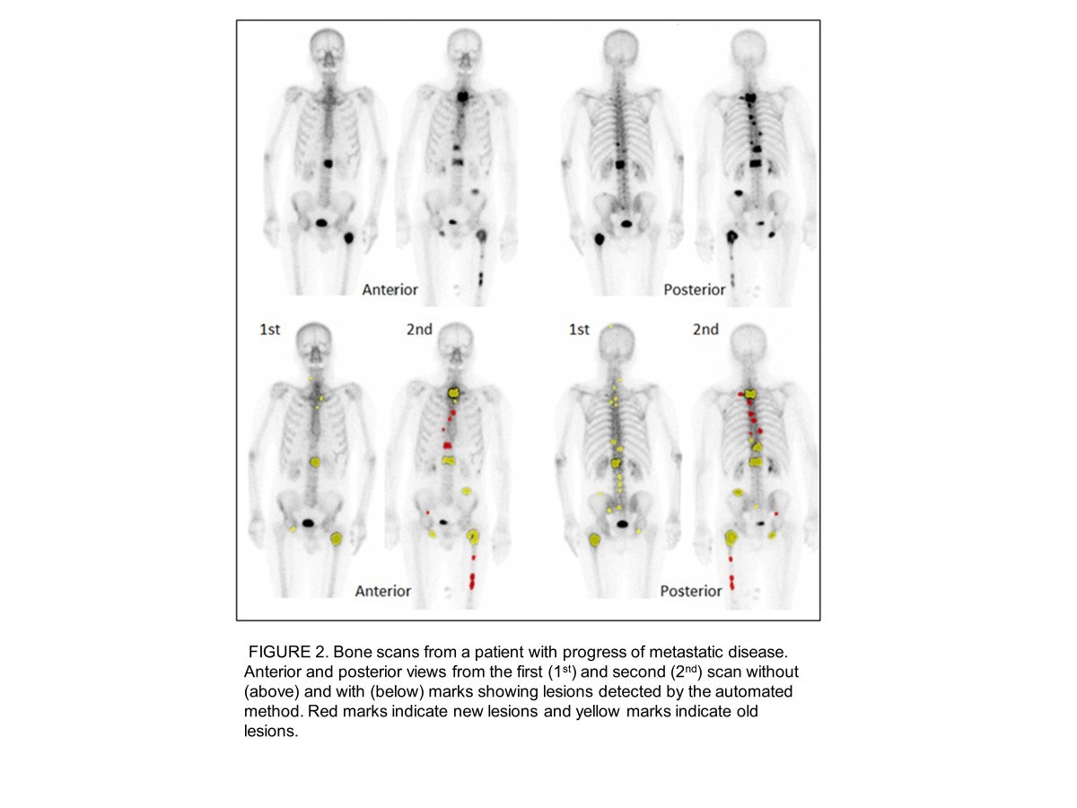 Progression of bone metastases in patients with prostate cancer - automated  detection of new lesions and calculation of bone scan index | EJNMMI  Research, image size:1200x900
