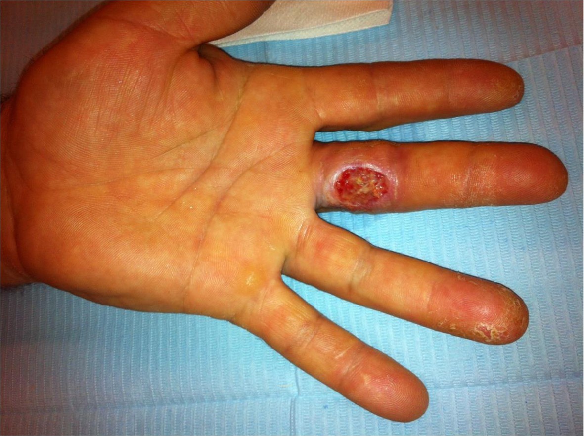 Third degree formic acid chemical burn in the treatment of a hand wart: a  case report and review of the literature | SpringerPlus