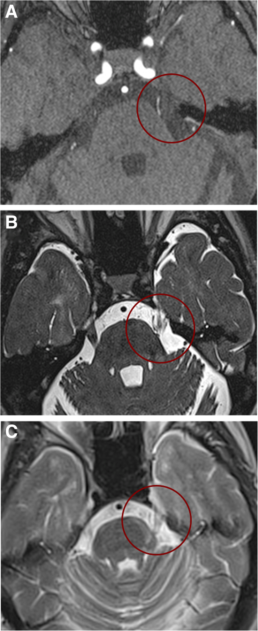 Trigeminal neuralgia secondary to multiple sclerosis: from the clinical  picture to the treatment options | The Journal of Headache and Pain, image size:894x2182