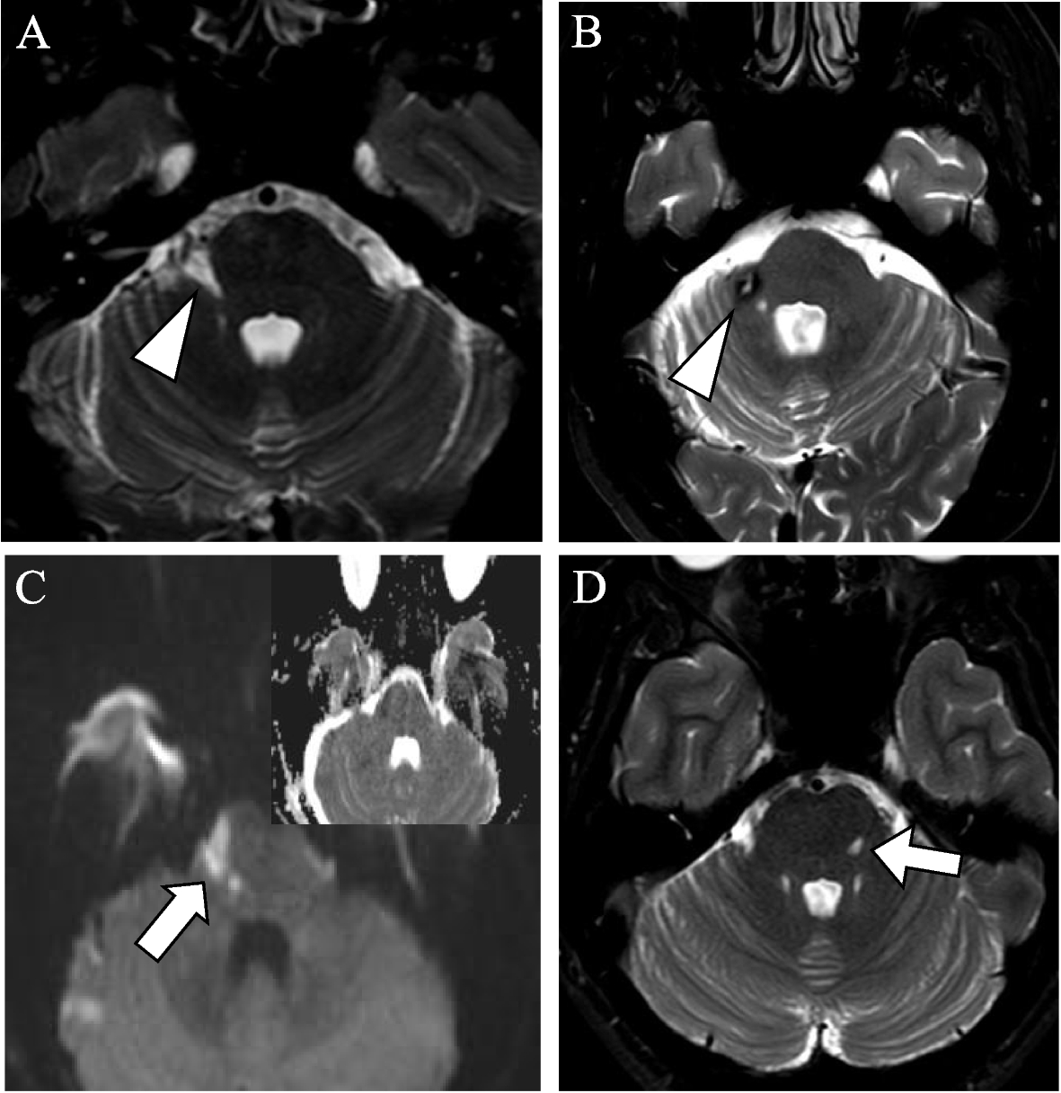 Advances in diagnosis and treatment of trigeminal neuralgia, image size:1181x1216