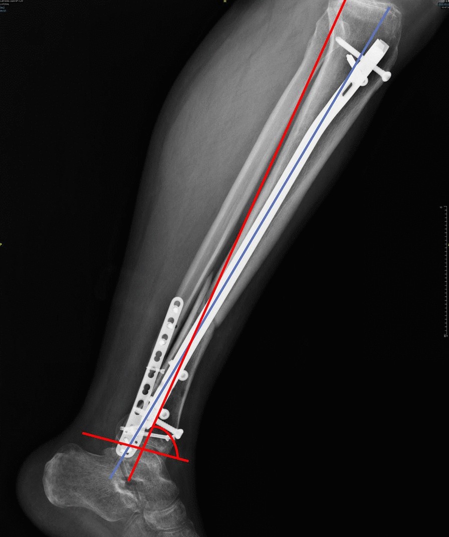 Removal of the Distal Aspect of a Broken Tibial Nail | MDedge Surgery