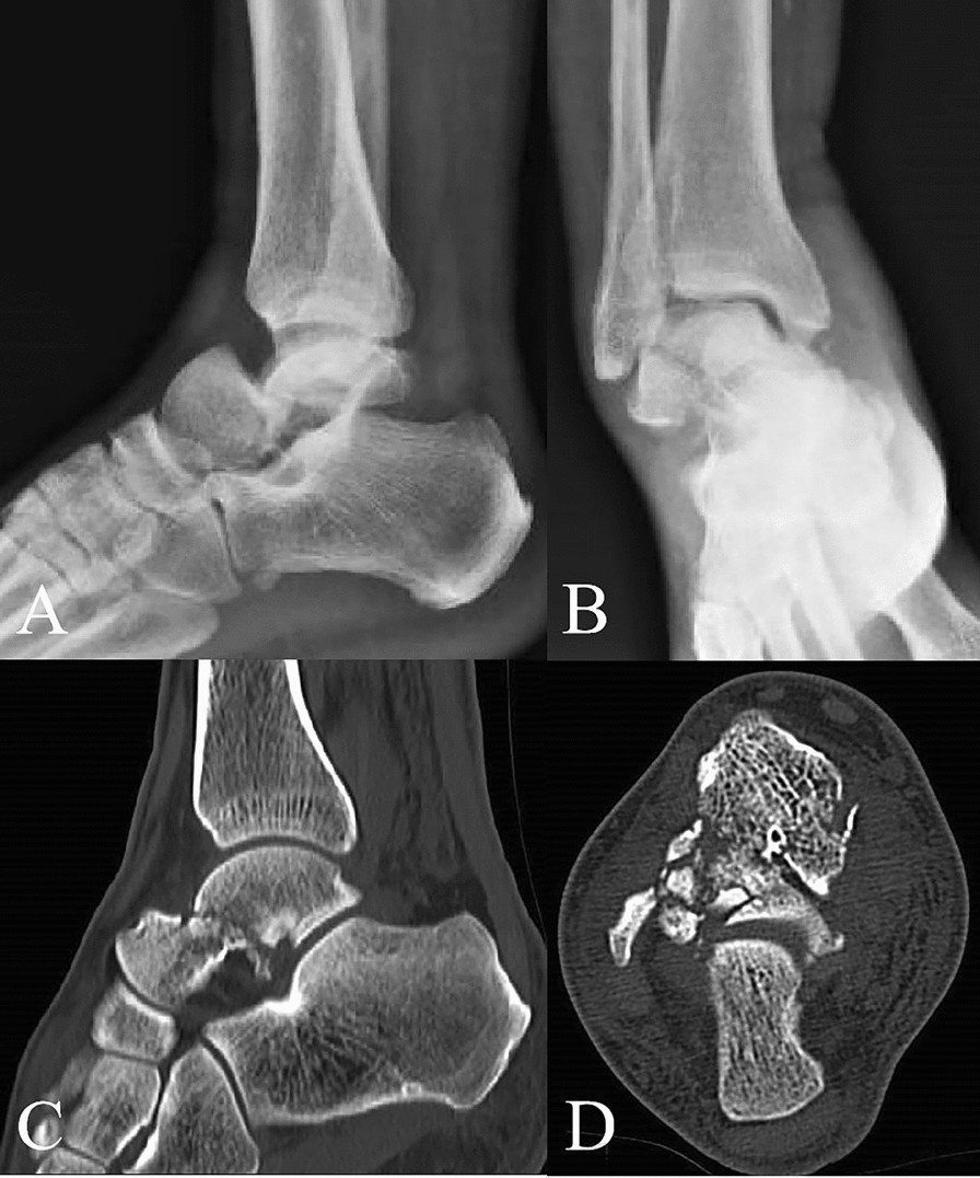 Efficacy analysis of arthroscopic reduction combined with orthopedic robot-guided  screw placement for Hawkins type II fractures of the talus neck | Journal  of Orthopaedics and Traumatology | Springer Nature Link