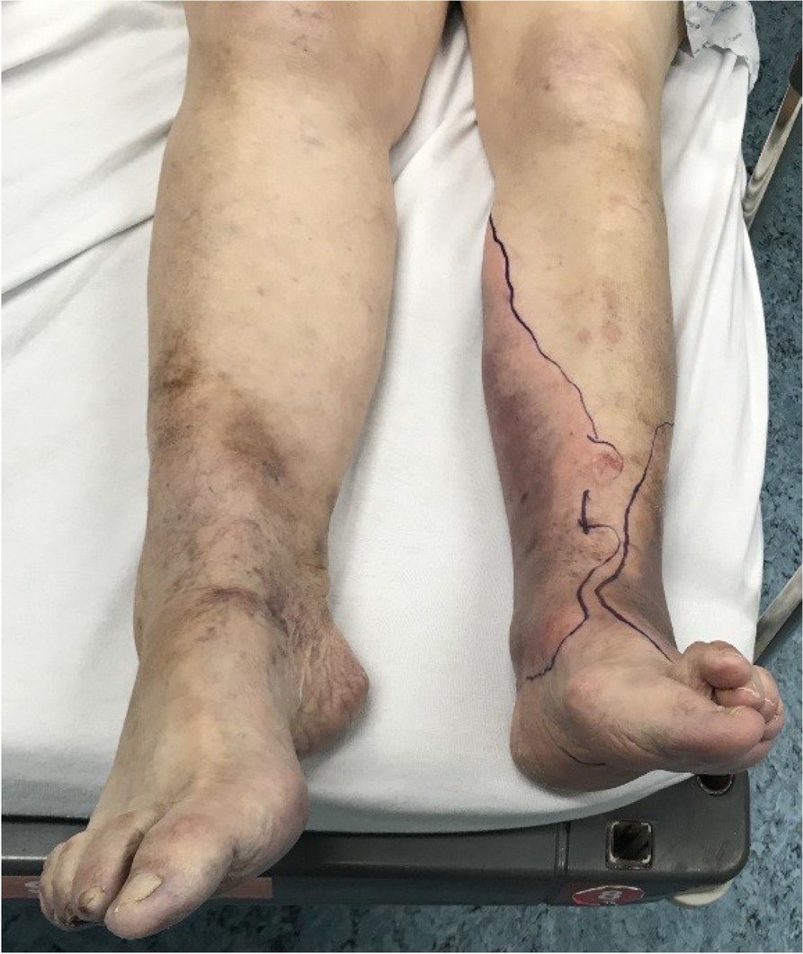 Clostridium myonecrosis — a rare and underdiagnosed condition in the  elderly: a case with severe skipping lesions and an overview of treatment  guidelines | International Journal of Emergency Medicine, image size:893x1060