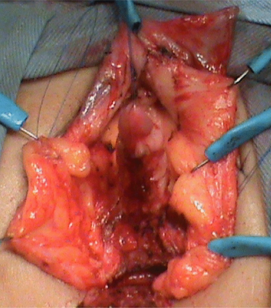 clitorectomy 