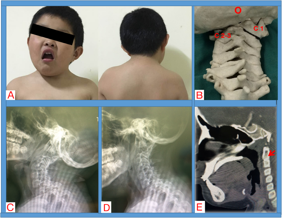 A rare case of difficult airway management in a Klippel-Feil syndrome  pediatric patient with osseous torticollis undergone orthopedic surgery |  BMC Anesthesiology, image size:1200x930