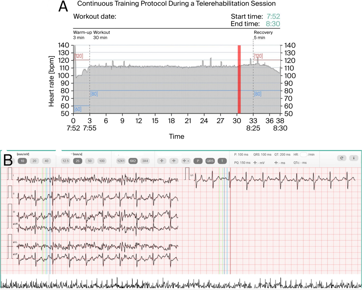 A case report of sinus node–sparing hybrid ablation for refractory sinus  tachycardia following cardioneuroablation for sinus node dysfunction | BMC  Cardiovascular Disorders | Springer Nature Link
