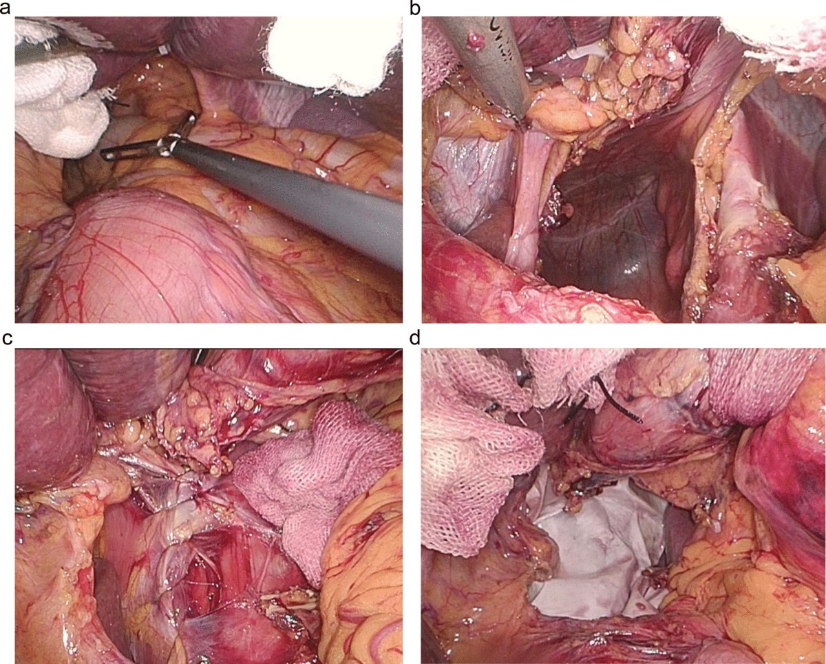 Post-operative gastric outlet obstruction of giant hiatal hernia repair: a  case report | BMC Gastroenterology | Springer Nature Link