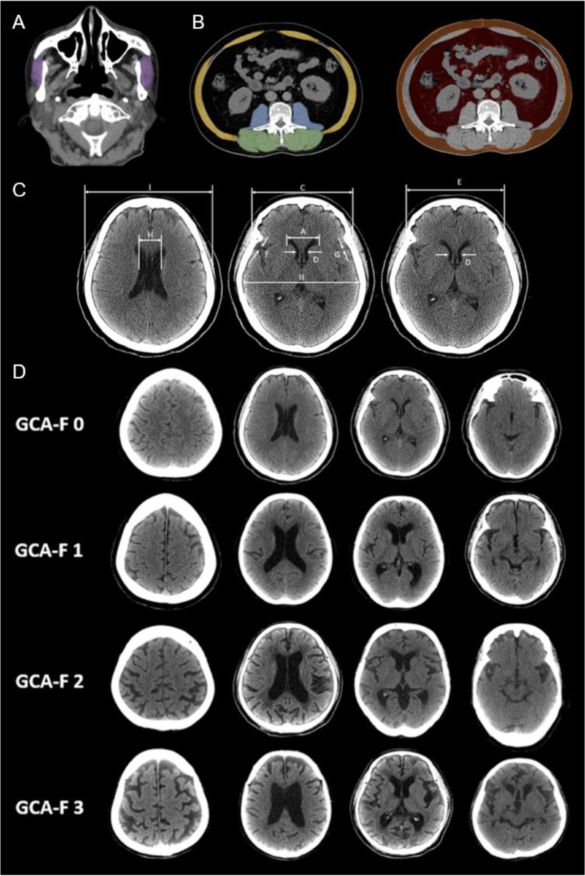 Brain CT can predict low lean mass in the elderly with cognitive 