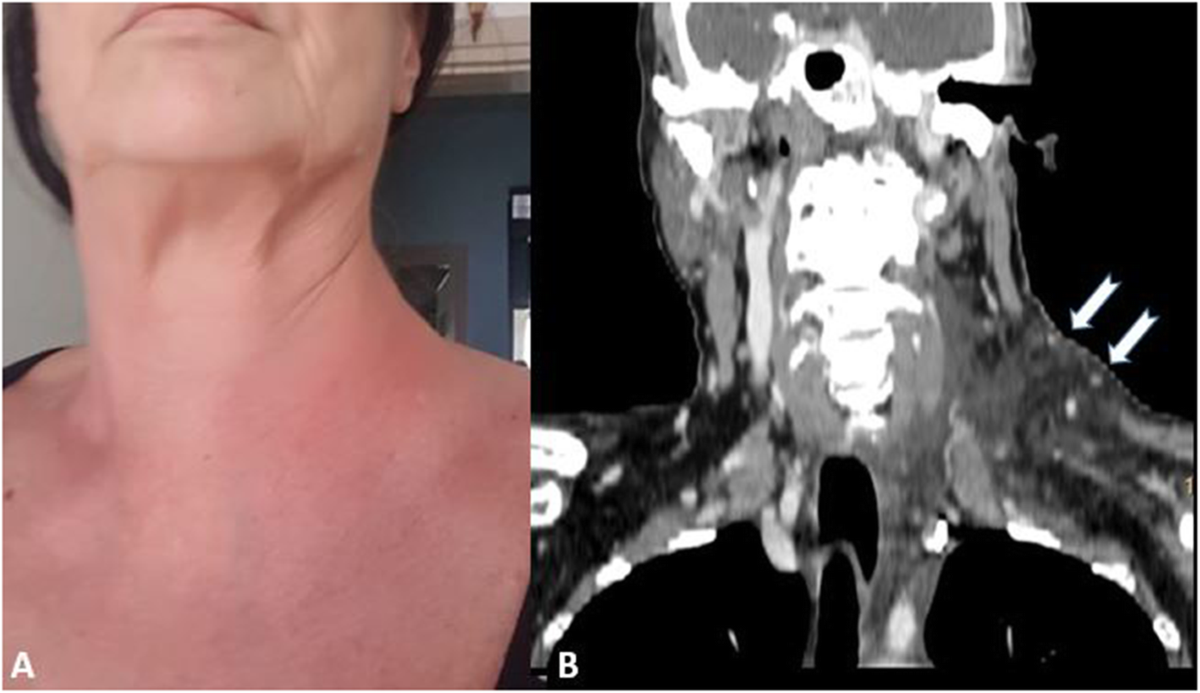 Sudden neck swelling with rash as late manifestation of COVID-19: a case  report, BMC Infectious Diseases