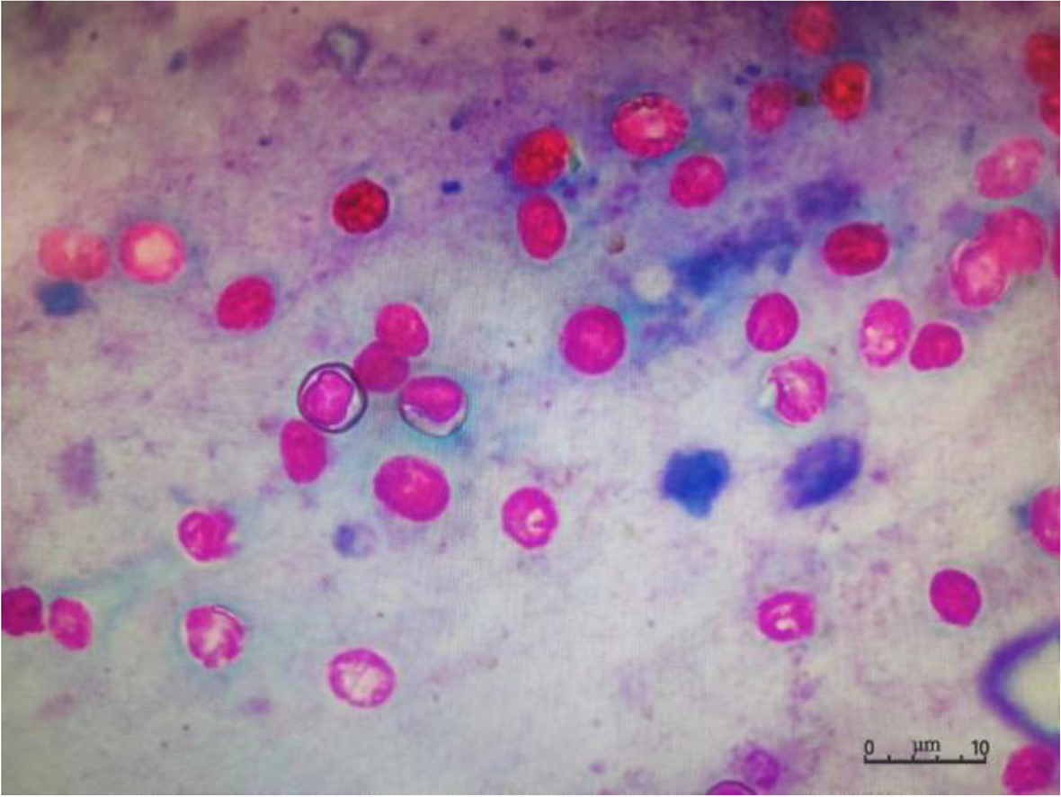A case of septic shock due to delayed diagnosis of Cryptosporidium  infection after liver transplantation | BMC Infectious Diseases | Springer  Nature Link