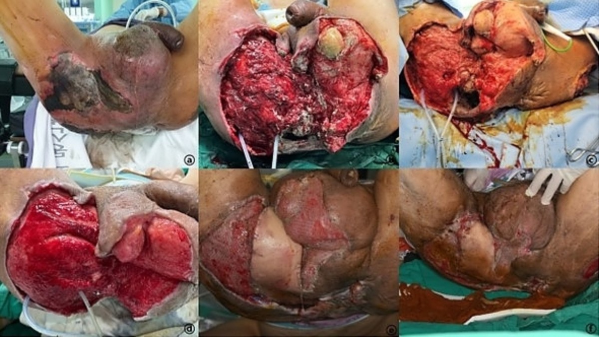 Prognostic factors and clinical outcomes in Fournier's Gangrene: a  retrospective study of 35 patients | BMC Infectious Diseases, image size:1200x675