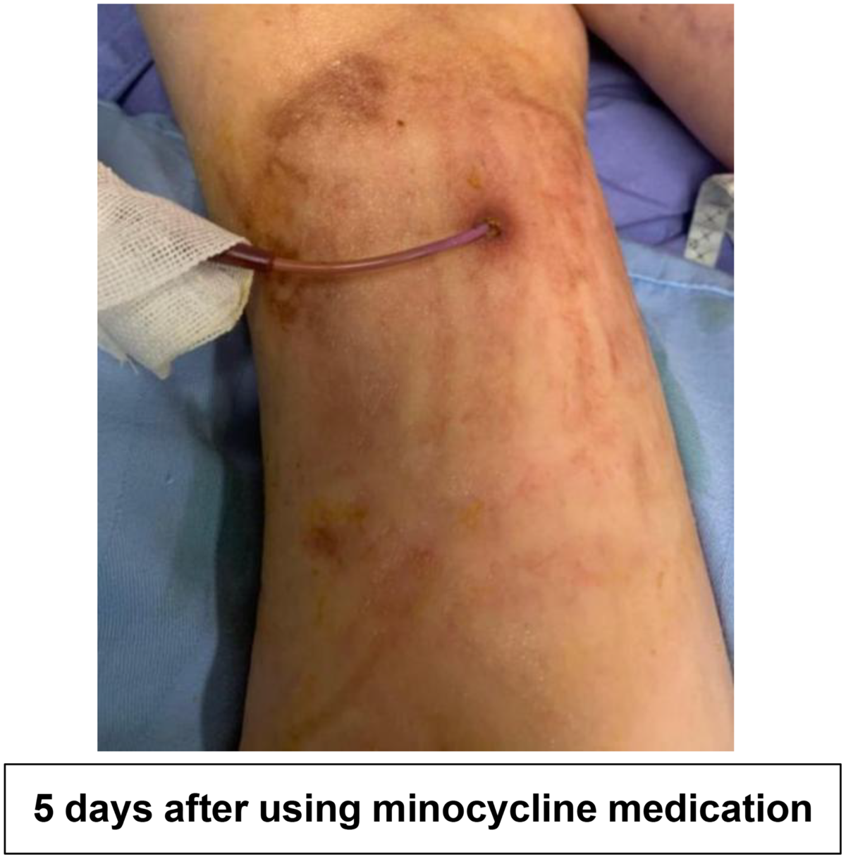 Successful salvage of a PICC in catheter-related bloodstream infection  caused by multidrug-resistant Ralstonia mannitolilytica using topical  minocycline: a case report | BMC Infectious Diseases | Springer Nature Link