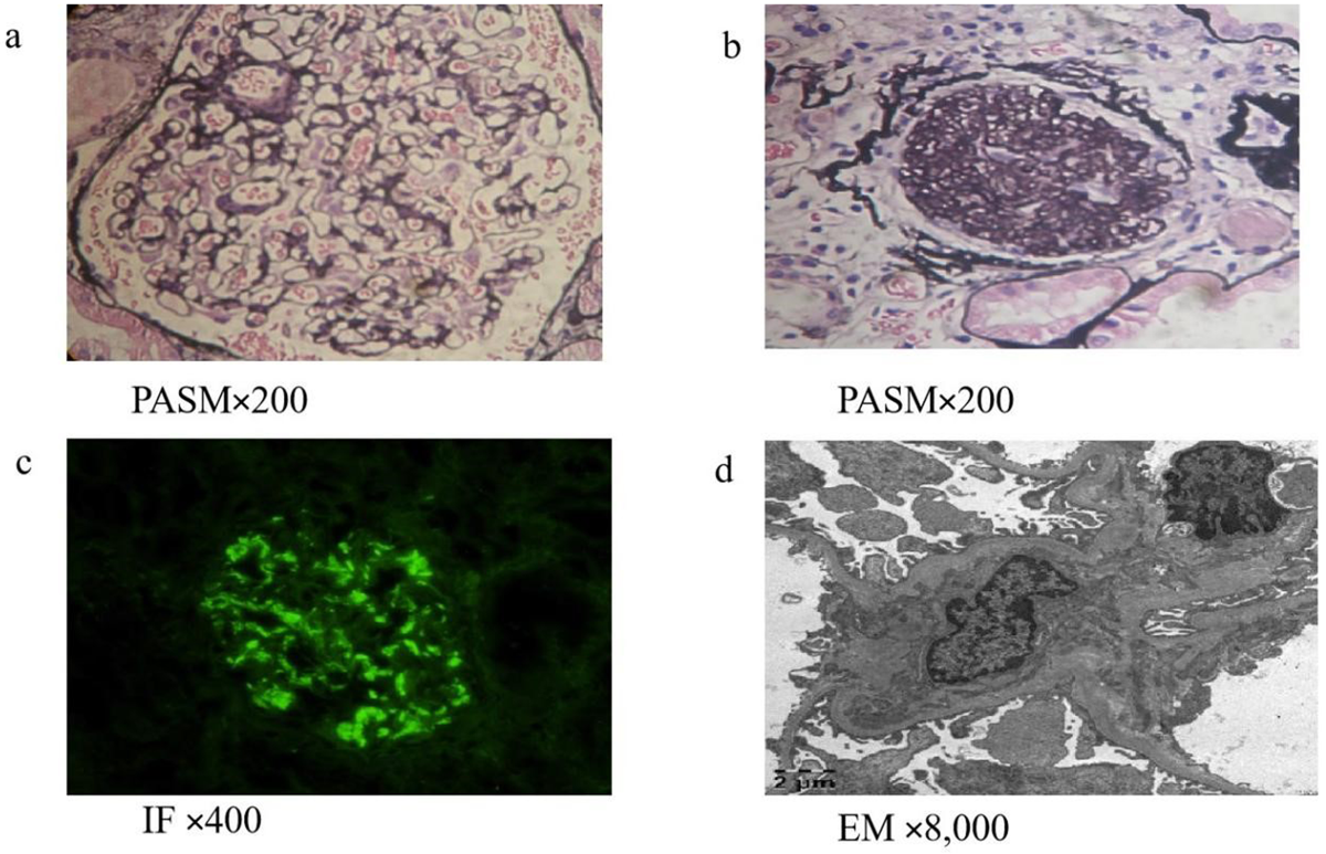 can semaglutide cause protein in urine Efficacy of semaglutide in IgA nephropathy with obesity: a case report |  BMC Nephrology