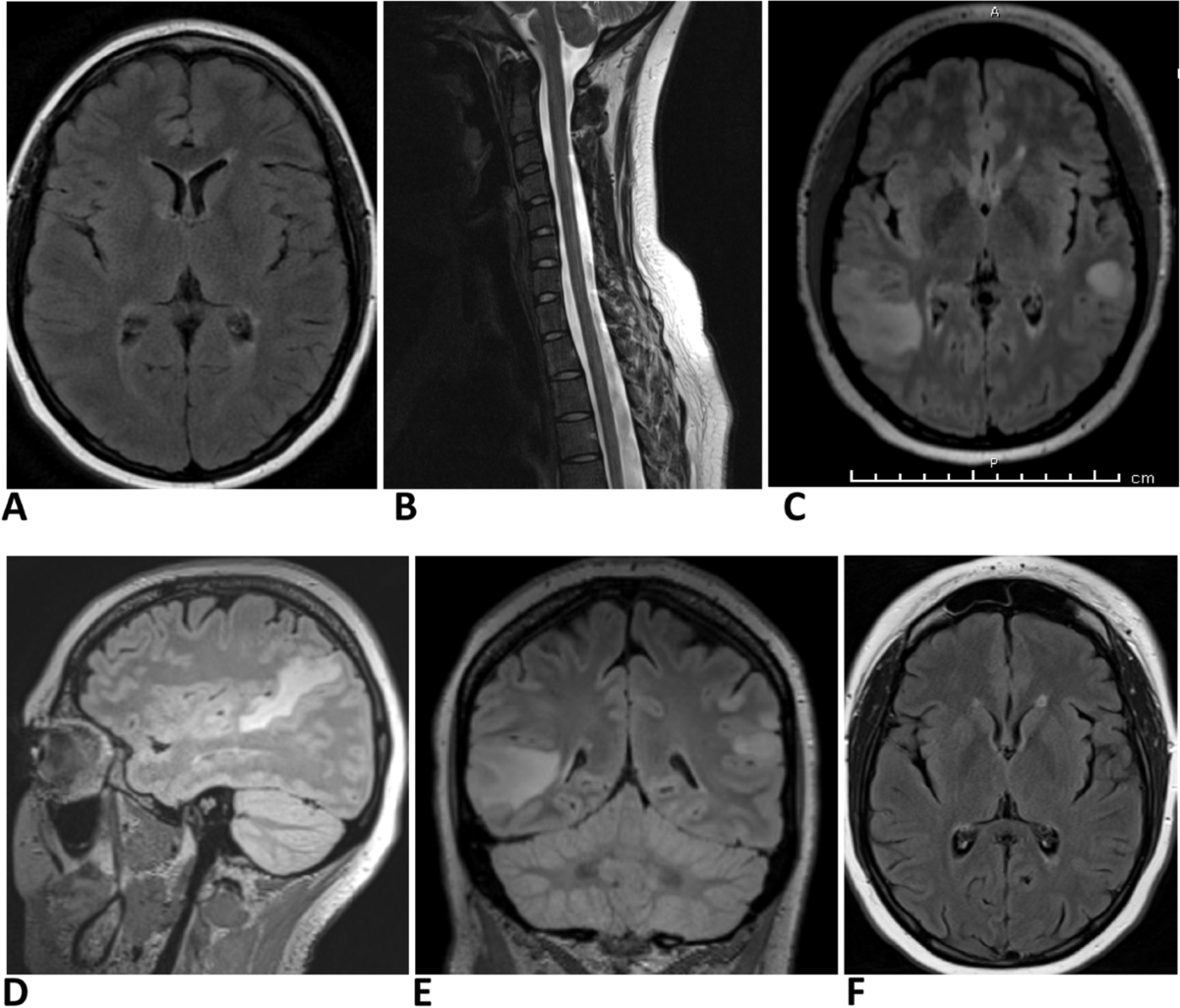 Failure of alemtuzumab therapy in three patients with MOG antibody  associated disease | BMC Neurology | Springer Nature Link