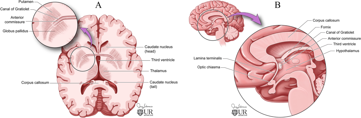 ganglia hemorrhage retatrutide A case of spontaneous basal ganglia hemorrhage with contralateral extension  utilizing the canal of Gratiolet | BMC Neurology